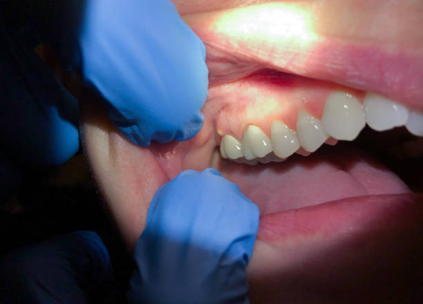 Best Emergency Root Canal Treatment in Red Cloud, NE